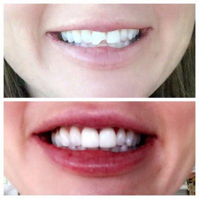 Before and after for cleaning and two front veneers to replace chipped tooth!