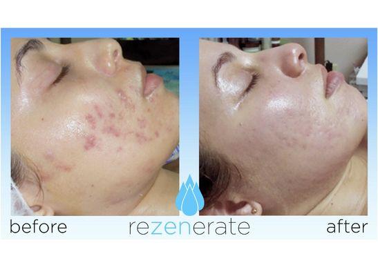 Acne or acne scars can be reduced or completely removed by nano facial .