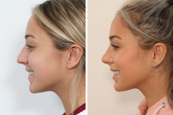 2 months after rhinoplasty with Dr. Ben Paul