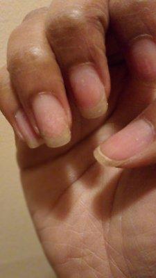 Damaged dry nails after a soak off.