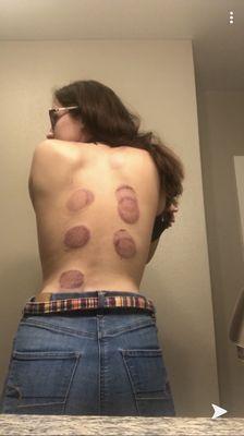 Post fire cupping