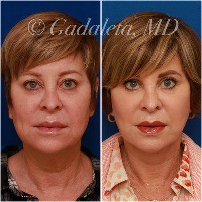 Before & After: Deep plane face and neck lift