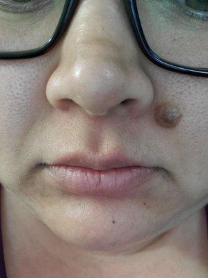 Still having clogged pores after Signature Hydrafacial