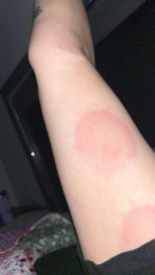 These are just a few pictures of the bites