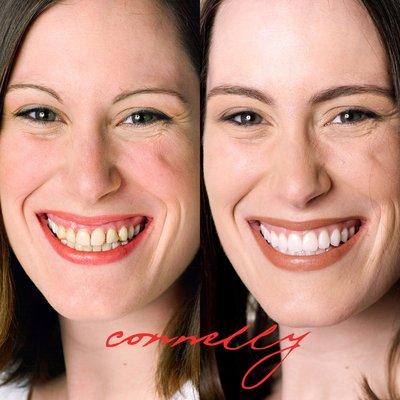 20 Porcelain Veneers