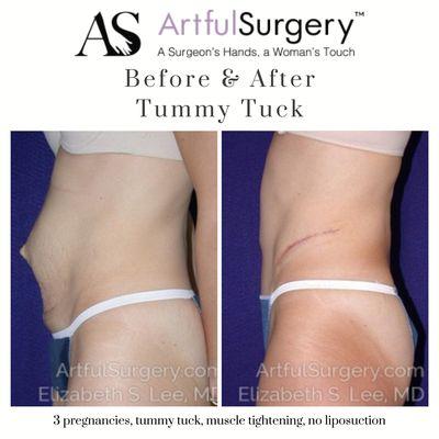 Tummy Tuck Before and After!