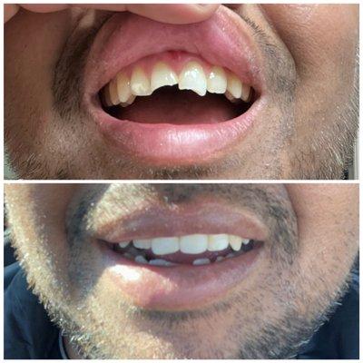 Before and after of the work done on my two front teeth at Cedarlake Dental