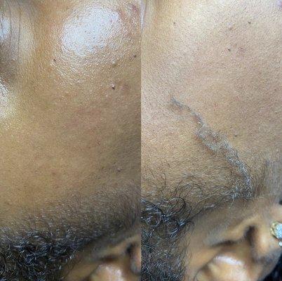 Dermaplaning before & after