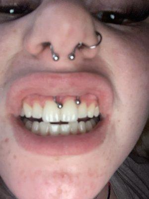 centered over left tooth