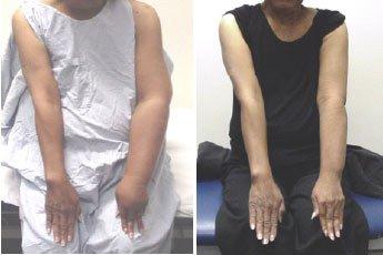 Typical results of Lymphedema therapy