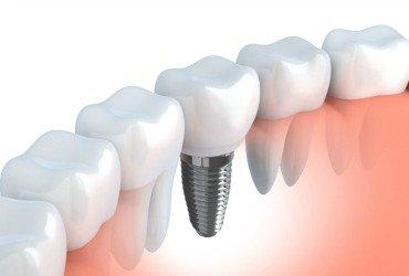 Dental Implants