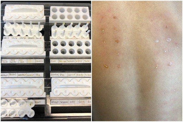 the skin test is the first test they do. they press the allergens (left) onto the child's back (right) to see how they react