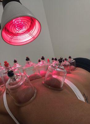 Cupping