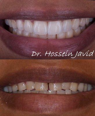 Before & After #Cosmetic Veneers & Bonding Culver City, Beverly Wood, Cheviot Hills, Palms, Mar Vista, Ladera Heights, Mid Wilshire,