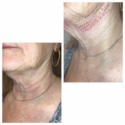 Fibroblast neck tightening