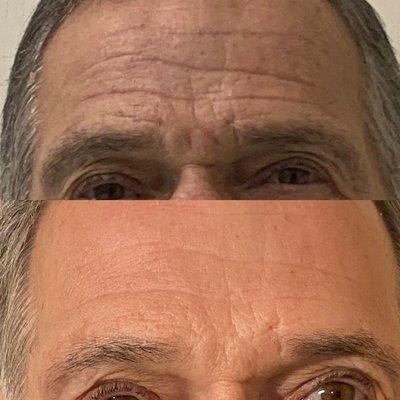 Before and after forehead fibroblasting treatment