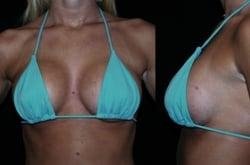 Gummy Bear Cohesive Anatomic Natural Appearing Breast Implants by Sadove