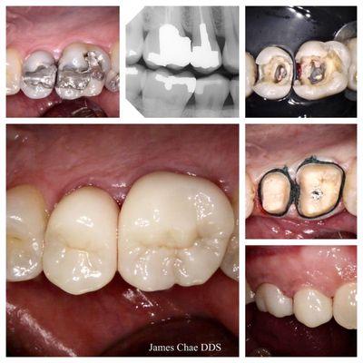 Katana Full zirconia crowns. The photos were taken right after the cementation.