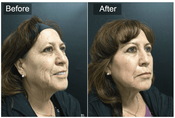 Our Juvaderm Voluma filler injections with CO2 laser therapy can restore volume, tighten skin and smooth wrinkle lines. #TimelessHealthMD