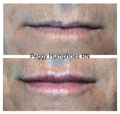 Lip Filler to enhance and restore shape and volume