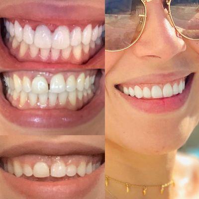 Bottom left : my original smile.  Middle: after gum surgery.  Upper left: temporaries.  Right : my now beautiful smile !