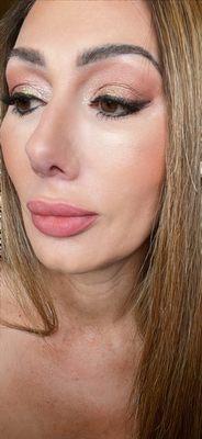 Revanesse Versa for my lips and nasal labial folds. 50 units of Botox for forehead and around eyes to soften wrinkles.