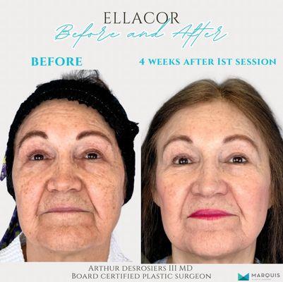 Skin tightening with Ellacor