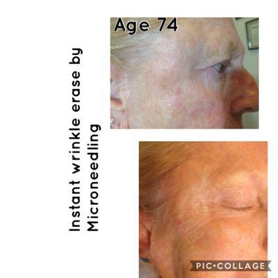 Treatment for loose skin and wrinkles Folsom