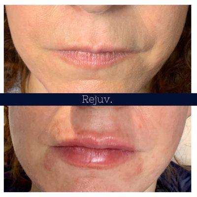 Lip filler augmentation