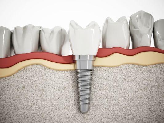 Dental Implant