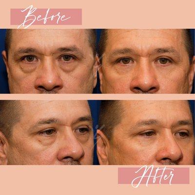 Lower eyelid surgery