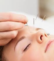 Acupuncture heals headaches, nerve pain, allergies and more!