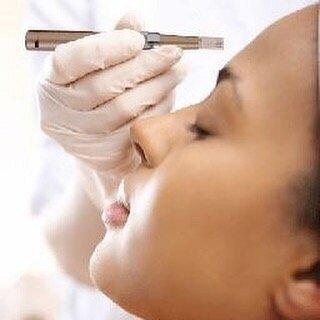 MicroNeedling Treatment $185 w/MicroCurrent Treatment