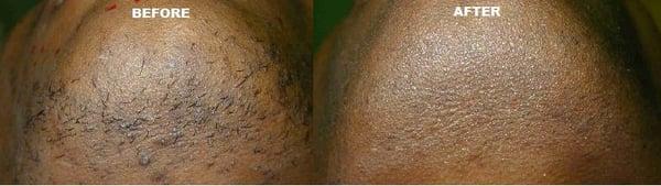 Laser Hair Removal - Chin - Before and After