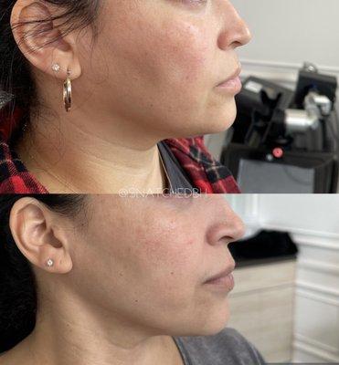 MORPHEUS8 SKIN TIGHTENING AND CONTOUR