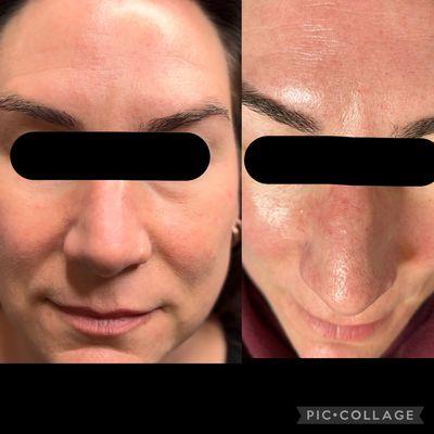 2 of 4 collagen induction treatments. Reduction in redness and texture. Photos unedited