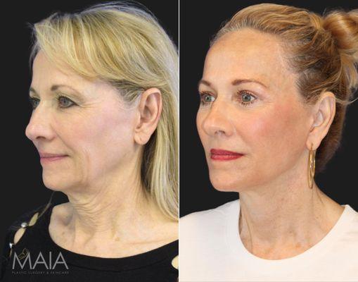 Dr. Maia completed a highly rigorous fellowship in Facial Plastic Surgery with world-renowned facial plastic surgeon Dr. Andrew Jacono.