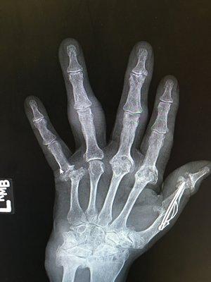 Rheumatoid Arthritis Hand and Wrist