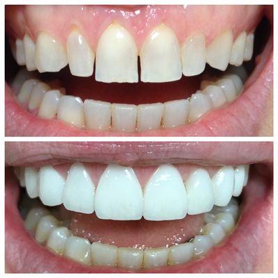 Porcelain veneers