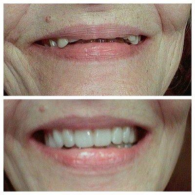 Dentures: Before & After