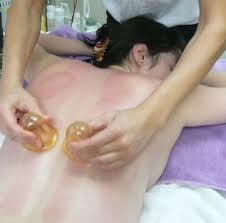 Cupping Massage is the treatment for you if you have limited ROM ,extreme knots and toxins , like a deep massage .