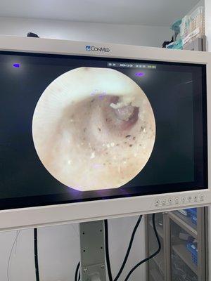 Otoscopy, ear deep cleaning