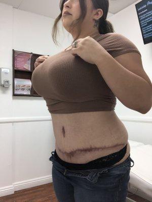 12 week post op scar