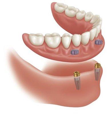 Implant overdenture attaches to two (or four) "Locator abutments."