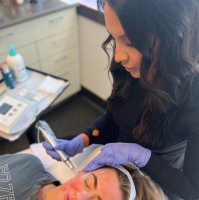 Exceed Microneedling with Kelly