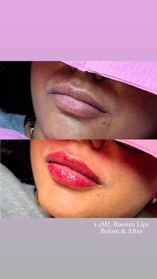 1.5ML Russian Lips - Before & After