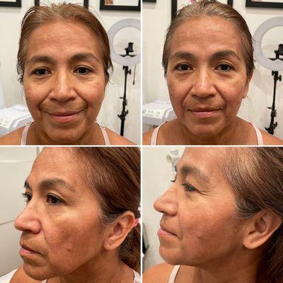 Microdermabrasion Facial