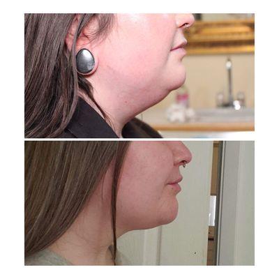 Permanent fat removal and skin tightening  with Kybella and Profound!