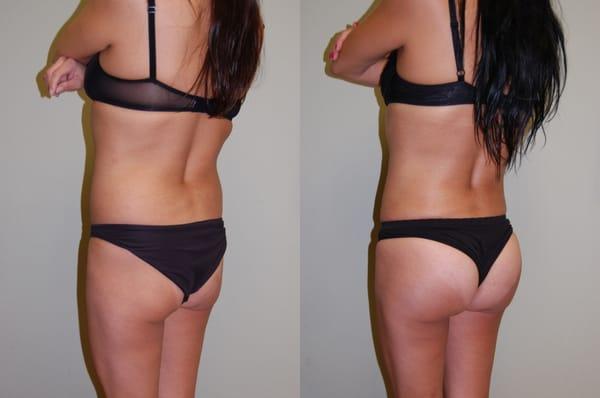 Add a captiButtock Augmentation with Implantson