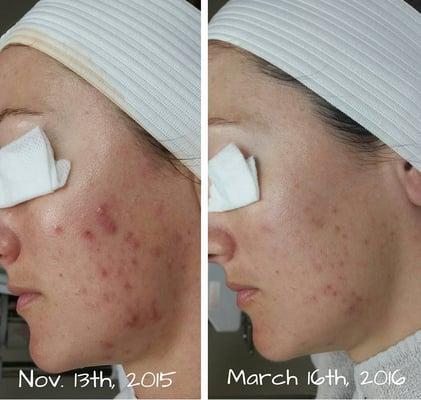 Excellent progress with the Face Reality acne program, in 4 months.